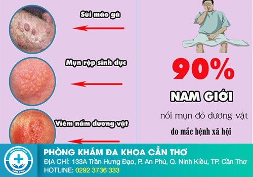 Các dấu hiệu của bệnh dương vật