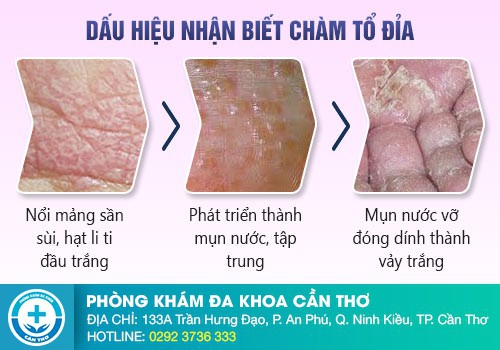 Bị ngứa bìu tinh hoàn là bệnh gì?