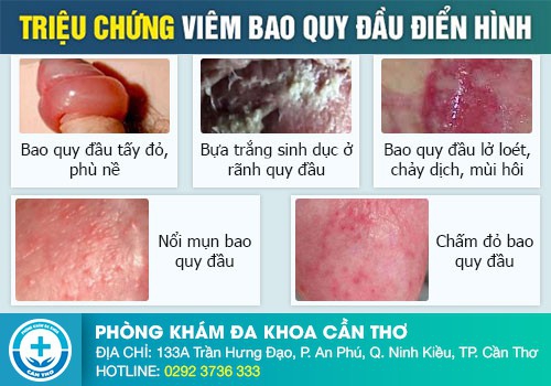 Đi tiểu buốt, tiểu rắt, tiểu nhiều lần là triệu chứng của bệnh gì?